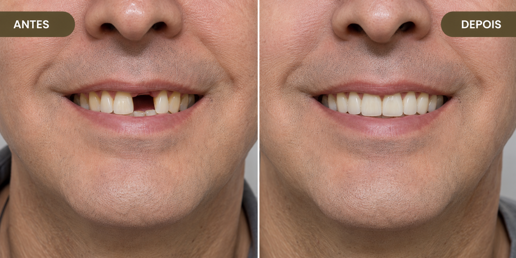 Antes e Depois - Implantes e Reabilitação Oral - Dr. Michel Platini